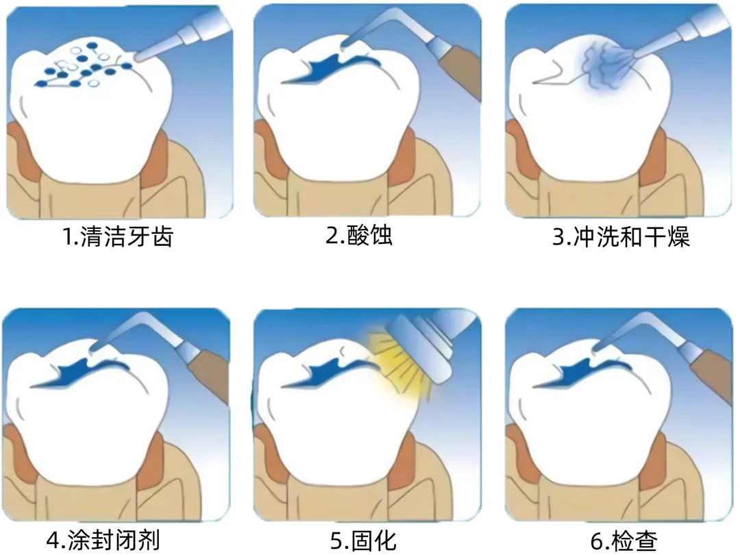 横琴小学二年级学生可免费做窝沟封闭